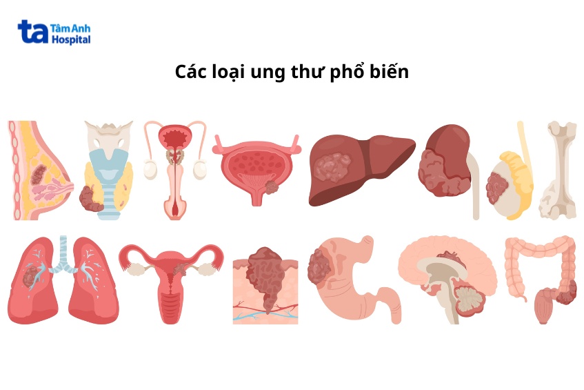 một số loại ung thư phổ biến