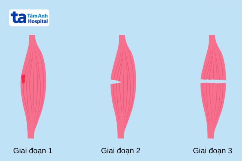 Mức độ chấn thương cơ