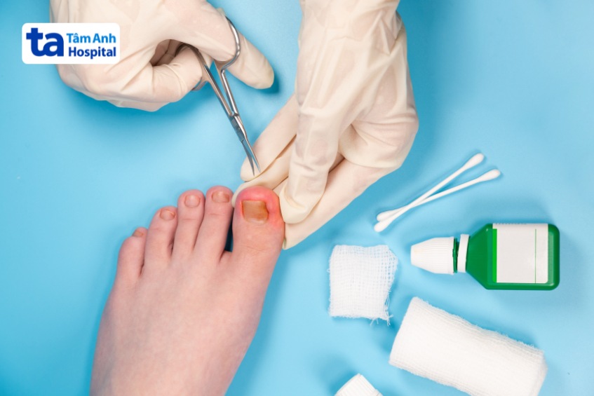 mức độ nghiêm trọng của móng chân mọc ngược