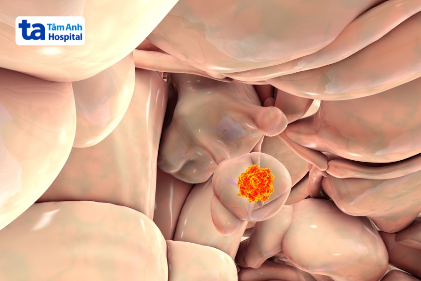 mục tiêu của phẫu thuật u sọ hầu