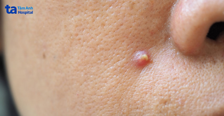 mụn chưa mủ trắng bên trong