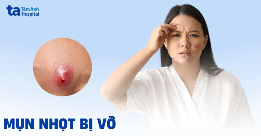 Mụn nhọt bị vỡ thì phải làm sao? Cách xử lý giảm thiểu rủi ro