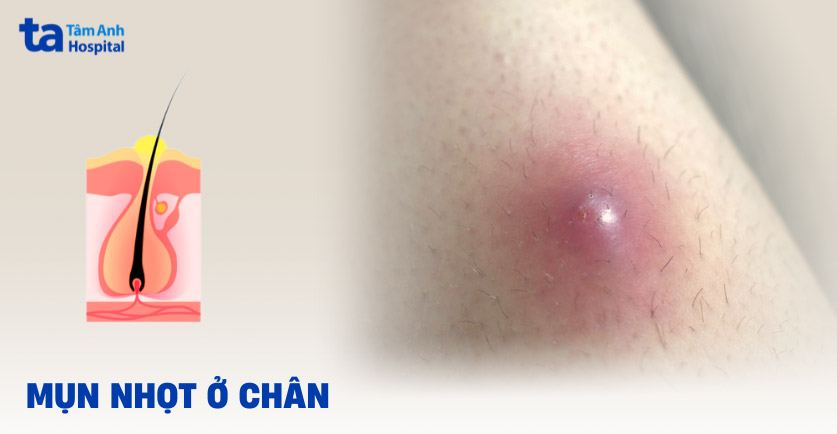 mụn nhọt ở chân