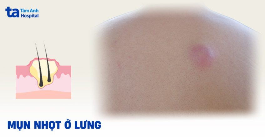 Mụn nhọt ở lưng: Hình ảnh, nguyên nhân, dấu hiệu, cách phòng ngừa