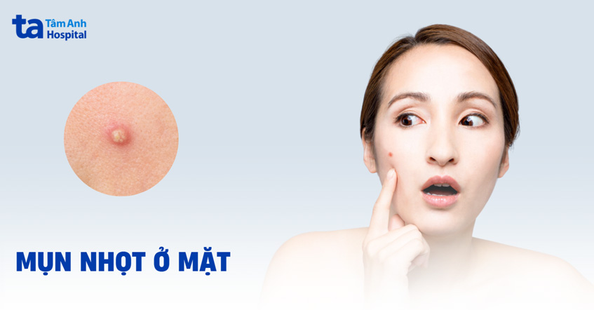Mụn nhọt ở mặt: Hình ảnh, nguyên nhân, dấu hiệu và cách điều trị