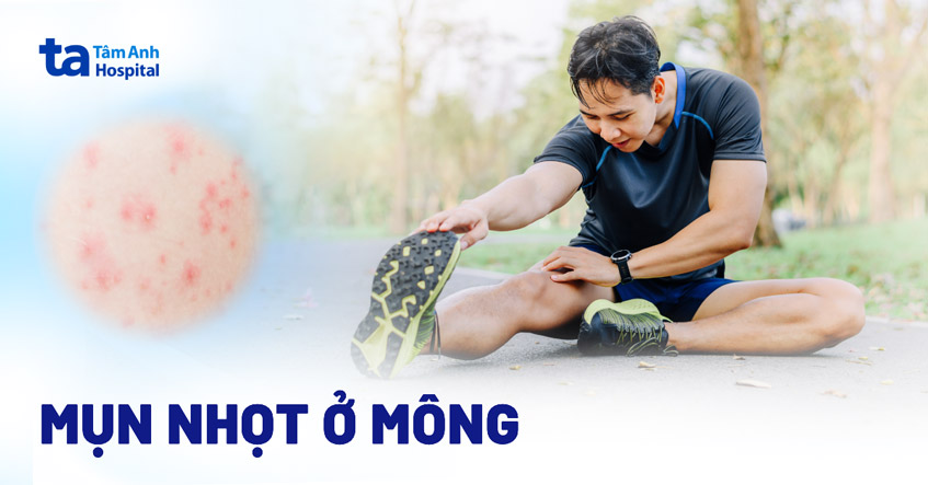 Mụn nhọt ở mông: Hình ảnh, nguyên nhân, dấu hiệu, phòng ngừa