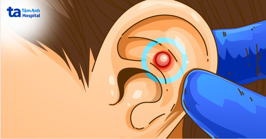 mụn nhọt ở tai gây đau nhức