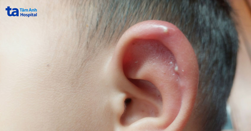 mụn nhọt ở tai là tình trạng nang lông bị bít tắc