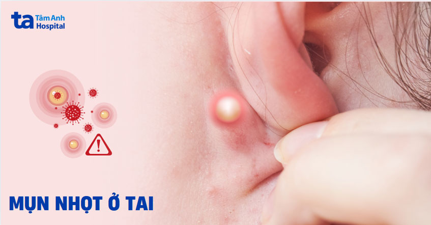 mụn nhọt ở tai