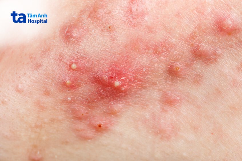 mụn sưng viêm nặng không được tiêm meso