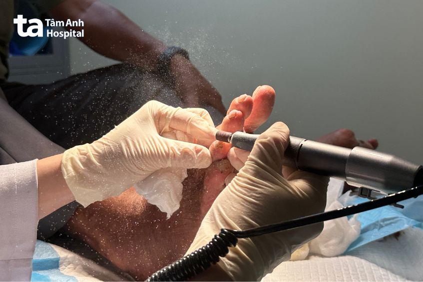 người bệnh được chăm sóc bàn chân, móng chân đúng cách