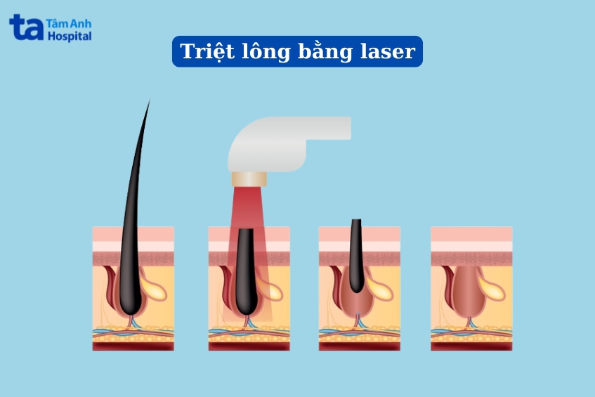 nguyên lý hoạt động phương pháp triệt lông vĩnh viễn