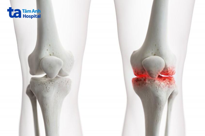 Nguyên nhân đau khớp gối ở người già