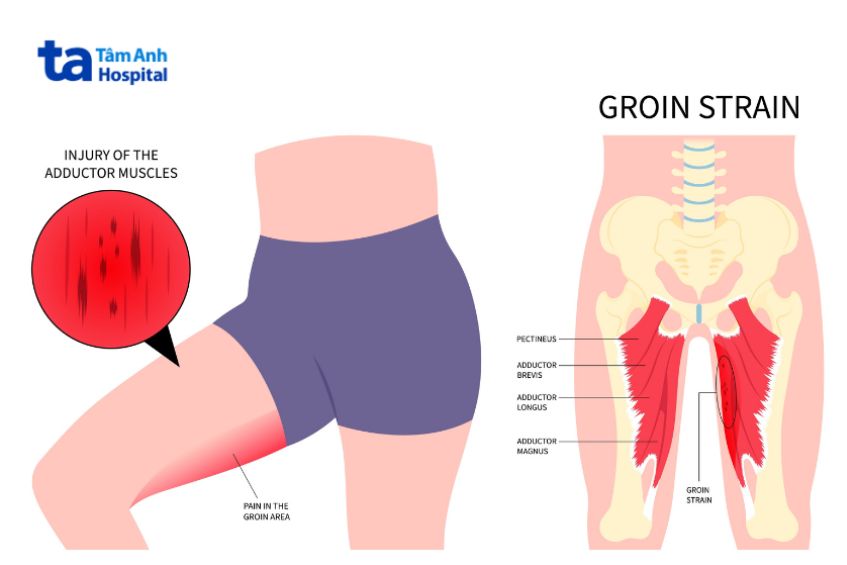 Nguyên nhân gây chấn thương vùng háng