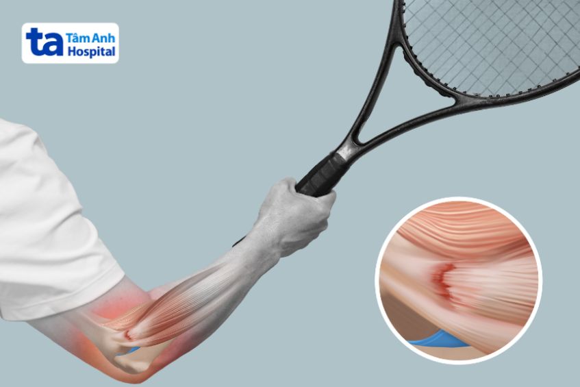 Nguyên nhân gây hội chứng Tennis Elbow