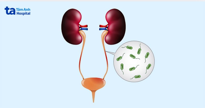 nguyên nhân phổ biến gây utis phổ biến là e.coli