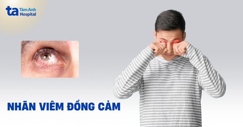Nhãn viêm đồng cảm là gì? Nguyên nhân, triệu chứng, điều trị