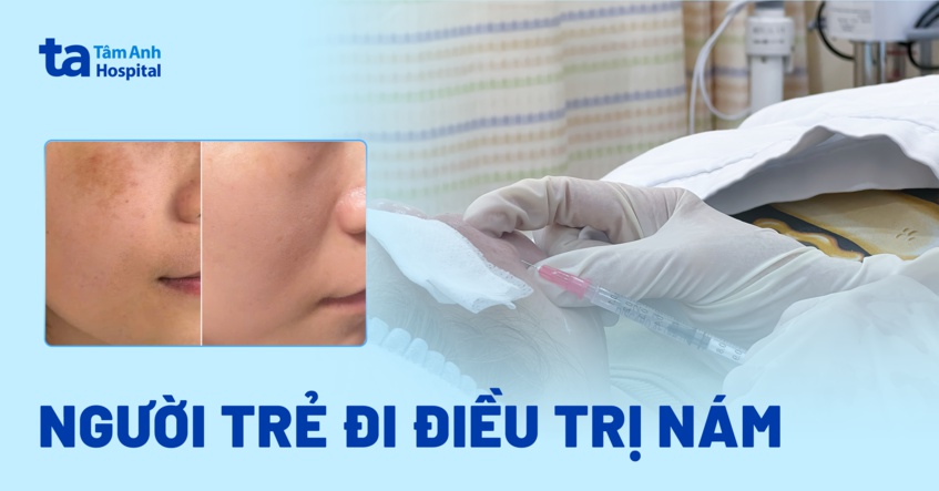 nhiều người trẻ điều trị nám