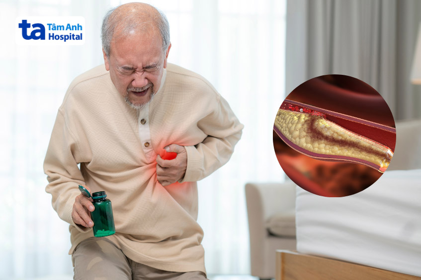 Những cơn đau thắt ngực xuất hiện thường xuyên hơn khi bị hẹp mạch vành 80%