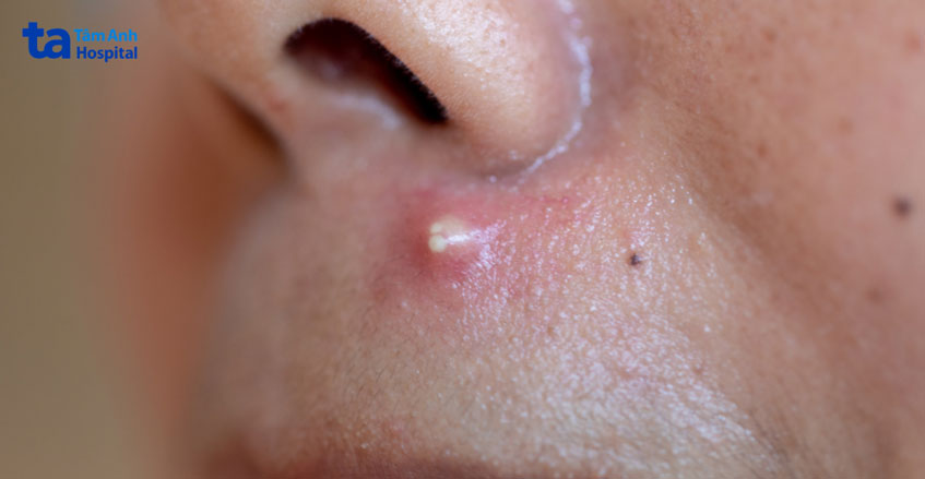 những vị trí dễ bị mụn nhọt