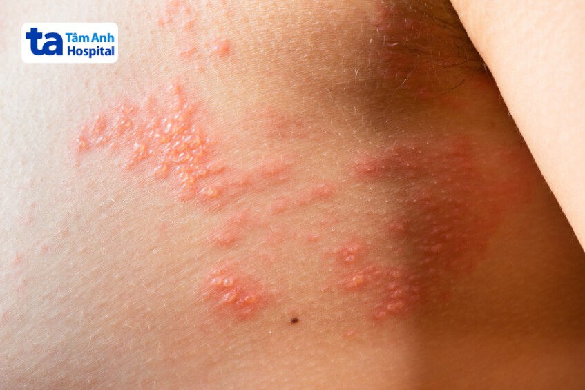 nổi mụn nước zona