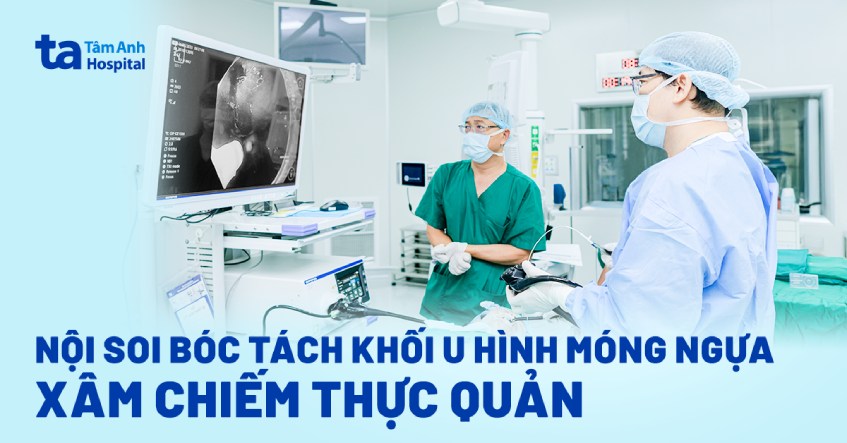 nội soi bóc tách khối u hình móng ngựa