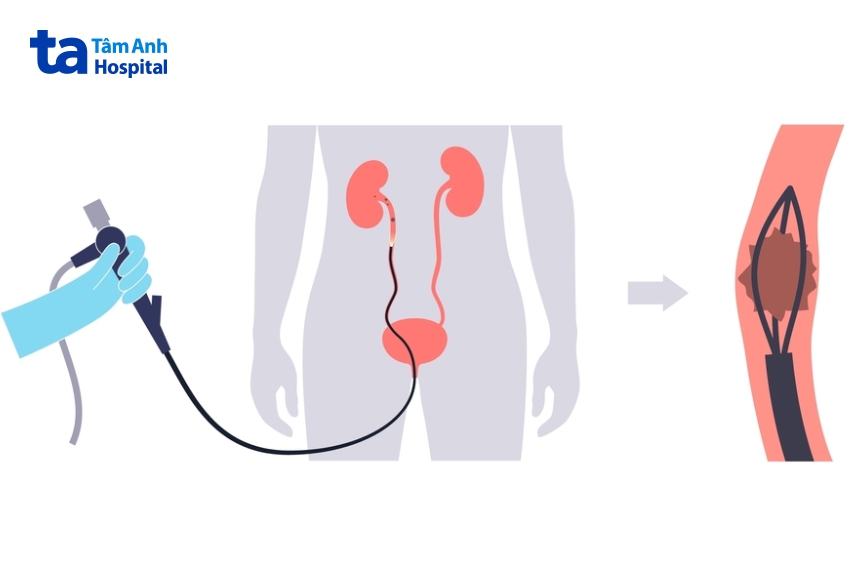 nội soi tán sỏi bằng ống mềm trong điều trị sỏi niệu quản