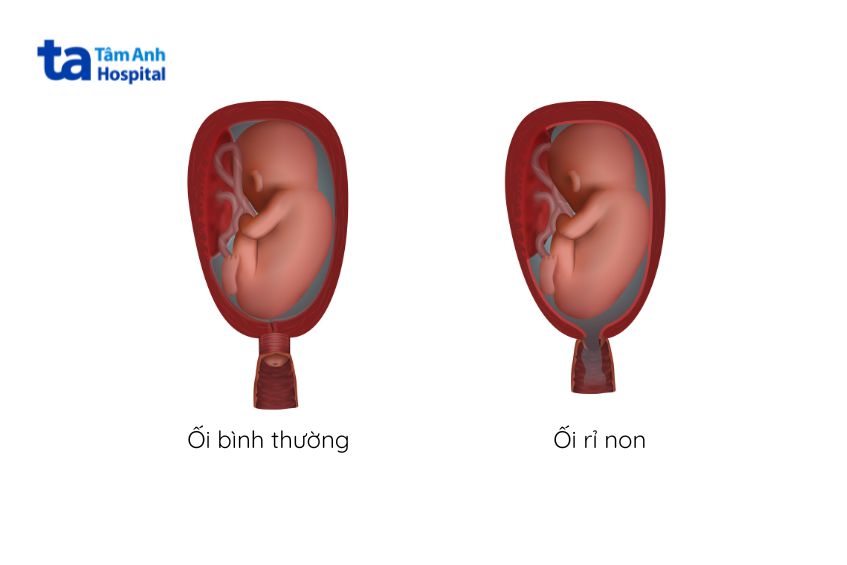 Ối rỉ non xảy ra ở tuổi thai càng nhỏ càng nguy hiểm