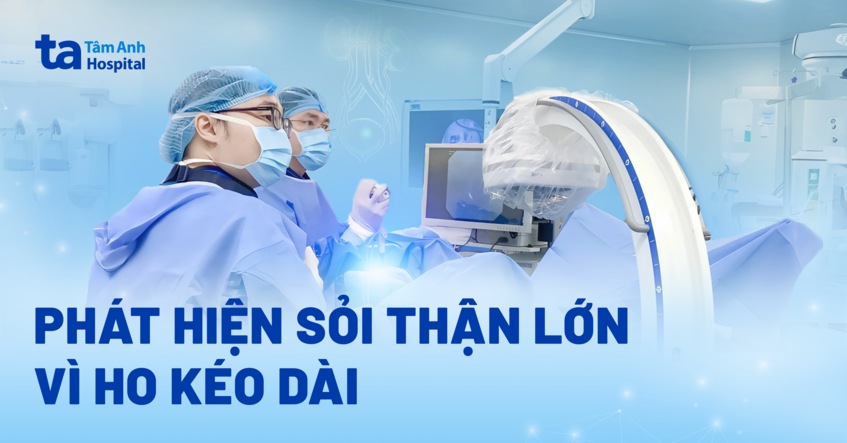 Phát hiện sỏi thận lớn khi đi khám vì ho kéo dài