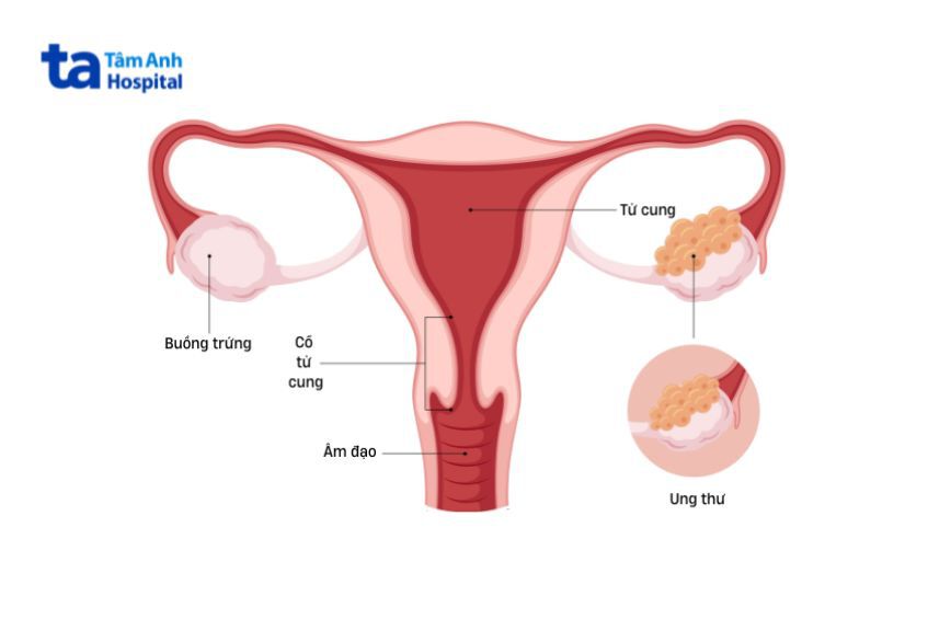 Sự phát triển bất thường của các tế bào trong buồng trứng có thể gây ra u nang buồng trứng ác tính