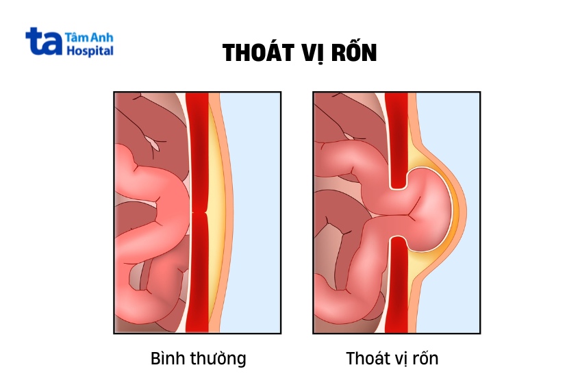 Phẫu thuật có thể được chỉ định để đưa thoát vị rốn về đúng vị trí