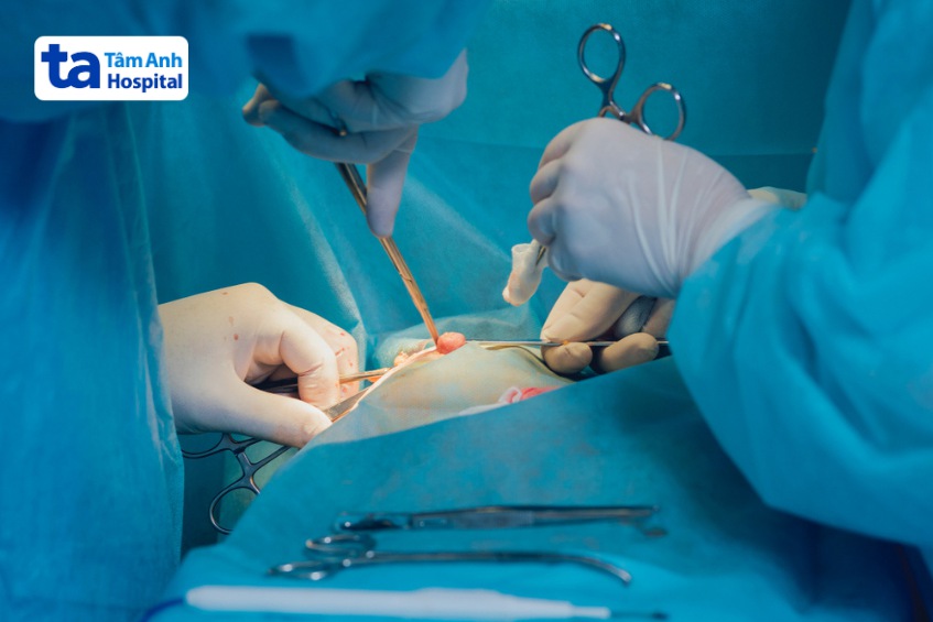 phẫu thuật loại bỏ áp xe