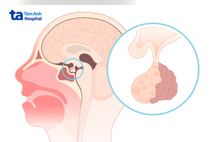 phẫu thuật mở nắp sọ