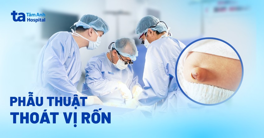 Phẫu thuật thoát vị rốn: Phương pháp và quy trình mổ