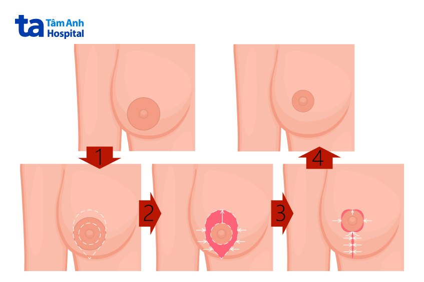 Phẫu thuật thu nhỏ quầng vú