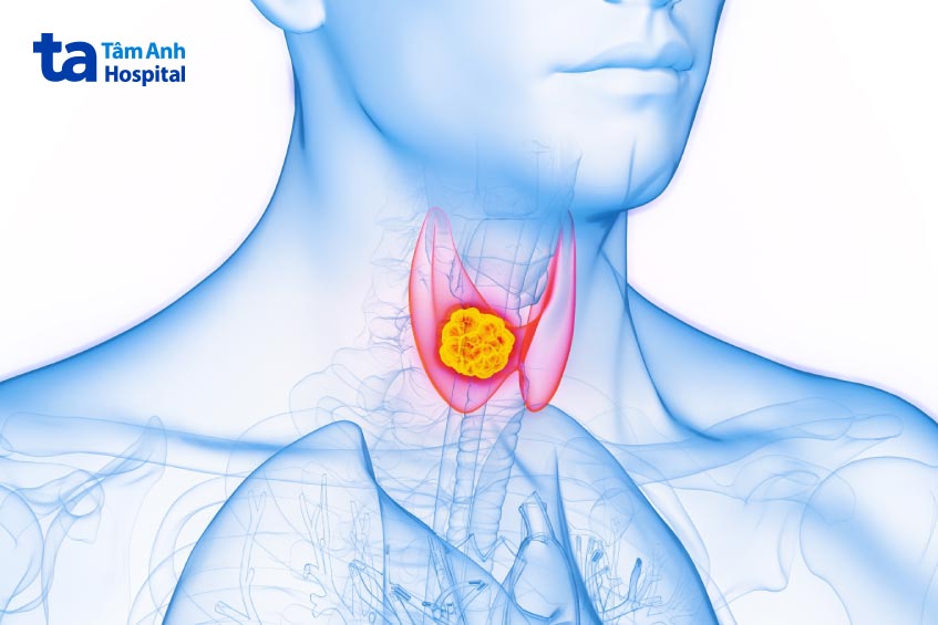 phẫu thuật tuyến giáp để trị ung thư