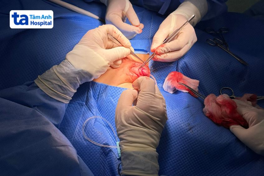 Phẫu thuật vùi dương vật cho trẻ tại BVĐK Tâm Anh 