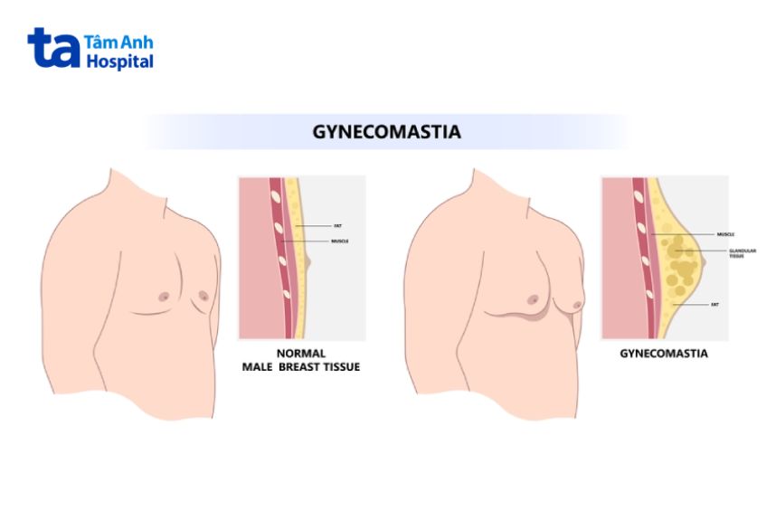 Phì đại tuyến vú ở nam giới là gì?