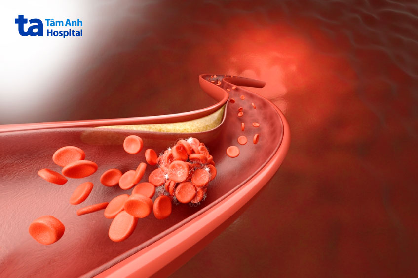 phương pháp chống chỉ định với người bệnh rối loạn đông máu