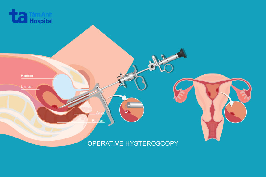 phương pháp loại bỏ mô sẹo