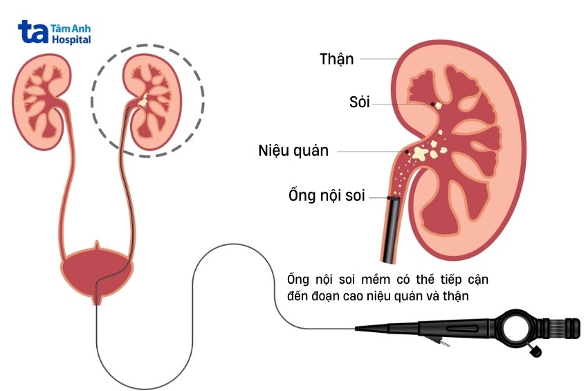 phương pháp tán sỏi nội soi ngược dòng
