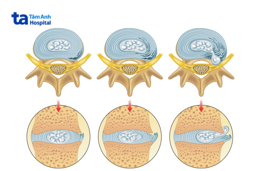 Rách bao xơ đĩa đệm là gì?