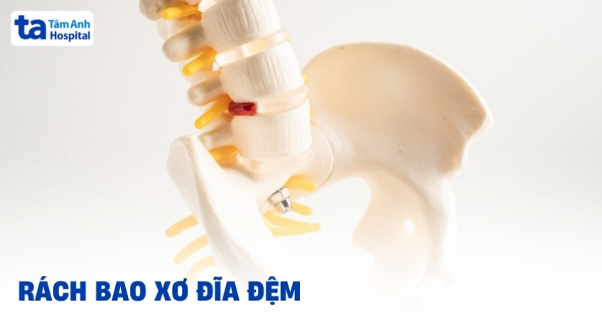 Rách bao xơ đĩa đệm: Nguyên nhân, triệu chứng và cách điều trị
