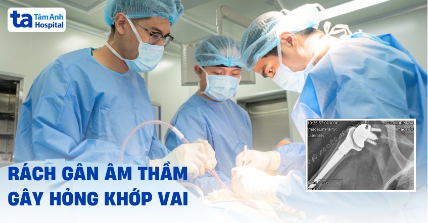 Rách gân âm thầm gây hỏng khớp vai