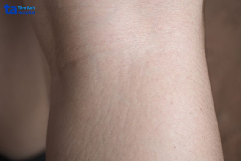 Rạn da chân có thể tự mờ đi sau 1 thời gian
