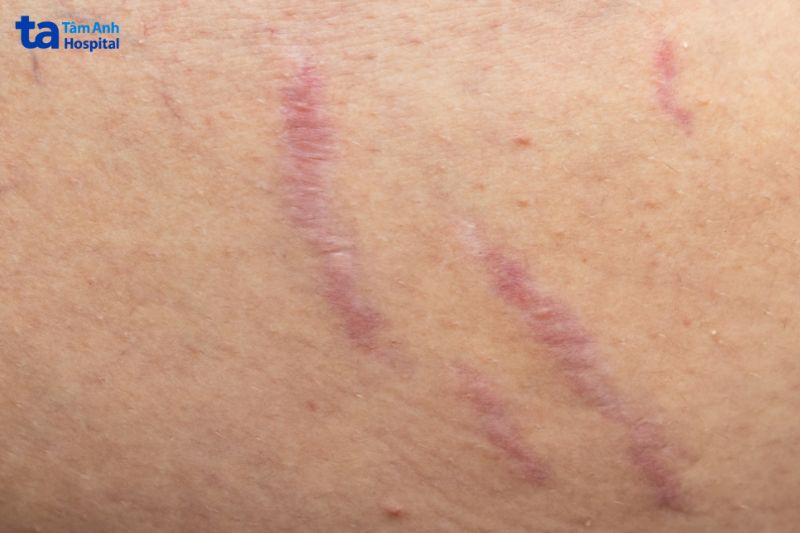 gia đoạn đầu rạn da thường có màu đỏ