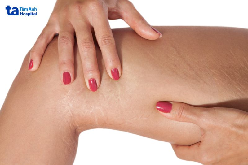 hình ảnh rạn da ở chân gần đầu gối