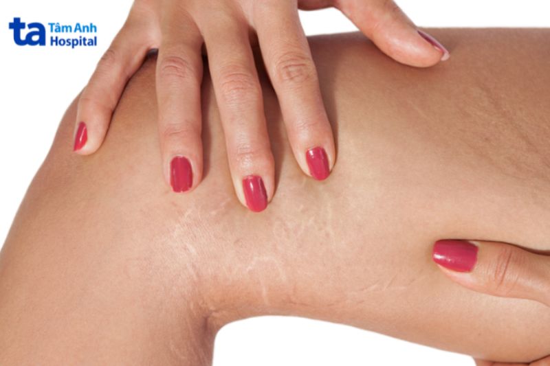 Những vết rạn da ở trắng đùi