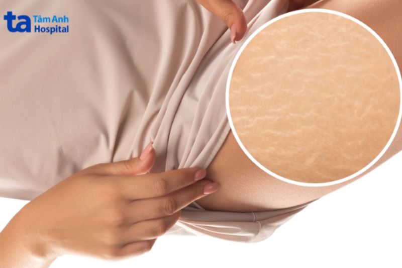 Rạn da trắng ở nữ giới