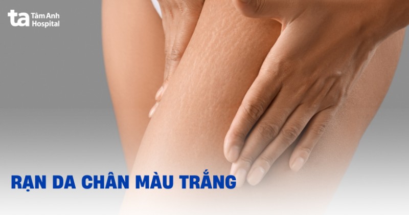 rạn da chân màu trắng